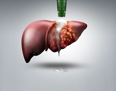 grade 1 fatty liver