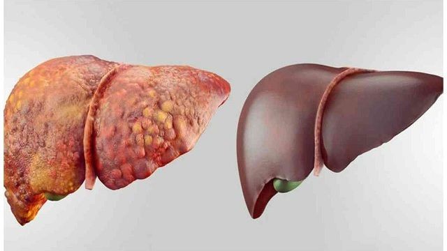 grade 1 fatty liver